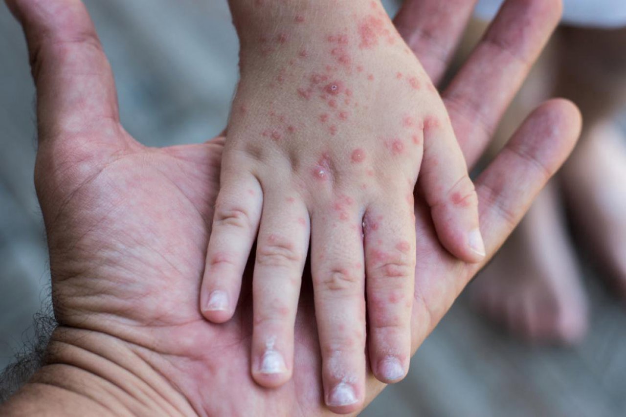 Peste 170 de cazuri de rujeolă, înregistrate de la începutul anului în R. Moldova. Câte cazuri sunt din r. Ialoveni 1 f2cc5453 dd23 478c 9989 50a1b3ddba9a